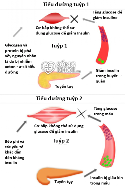 Chẩn đoán bệnh tiểu đường tuýp 1