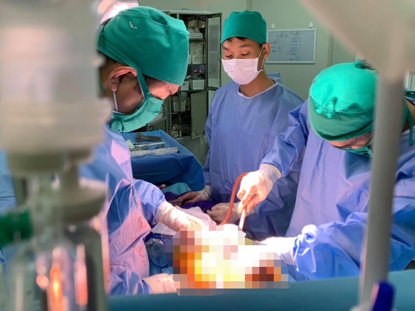 Phẫu thuật cắt khối u trung thất khổng lồ cho bệnh nhi tại Bệnh viện Sản Nhi Quảng Ninh