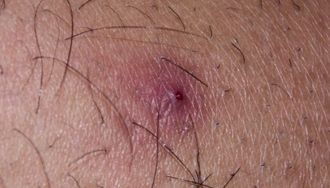 Triệu chứng 5 bệnh ngoài da thường gặp vào mùa hè