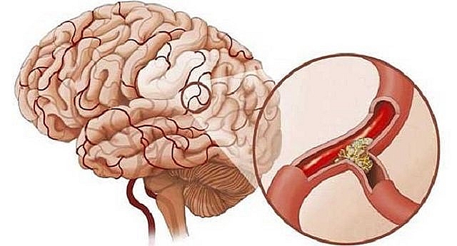 3 triệu chứng khó chịu khi ngủ cảnh báo bệnh nhồi máu não